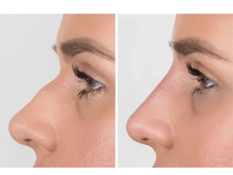 فیلر بینی و هر آنچه پیش از تزریق باید بدانید